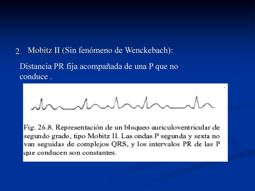 2. Mobitz II (Sin fenómeno de Wenckebach): Distancia PR fija acompañada de una P que no conduce .