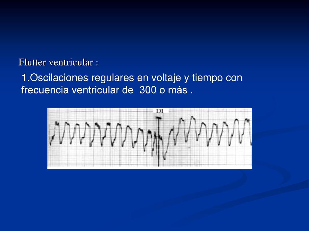 Flutter ventricular : 1.Oscilaciones regulares en voltaje y tiempo con frecuencia ventricular de 300 o más .