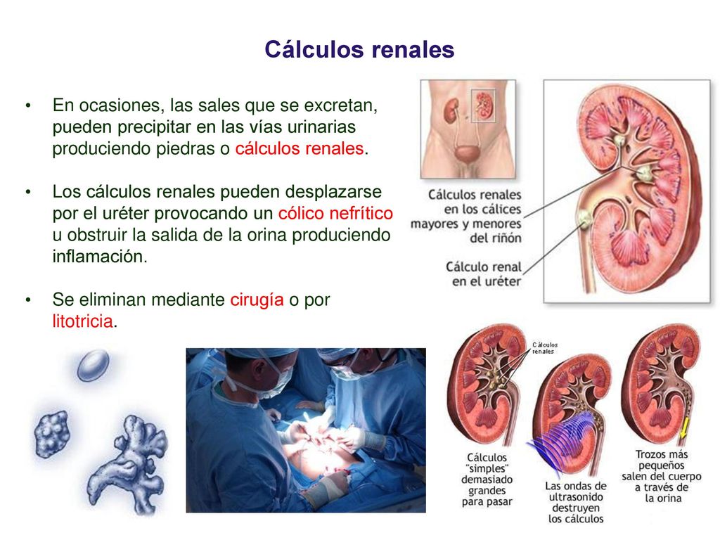 03 Cálculos renales. En ocasiones, las sales que se excretan, pueden precipitar en las vías urinarias produciendo piedras o cálculos renales.