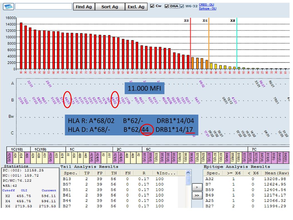 MFI HLA R: A*68/02 B*62/- DRB1*14/04 HLA D: A*68/- B*62/44 DRB1*14/17