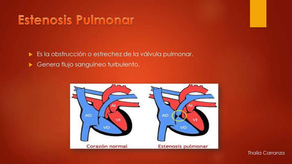 Estenosis Pulmonar Es la obstrucción o estrechez de la válvula pulmonar. Genera flujo sanguíneo turbulento.