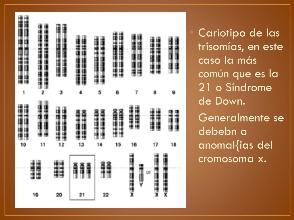 Cariotipo de las trisomías, en este caso la más común que es la 21 o Síndrome de Down.