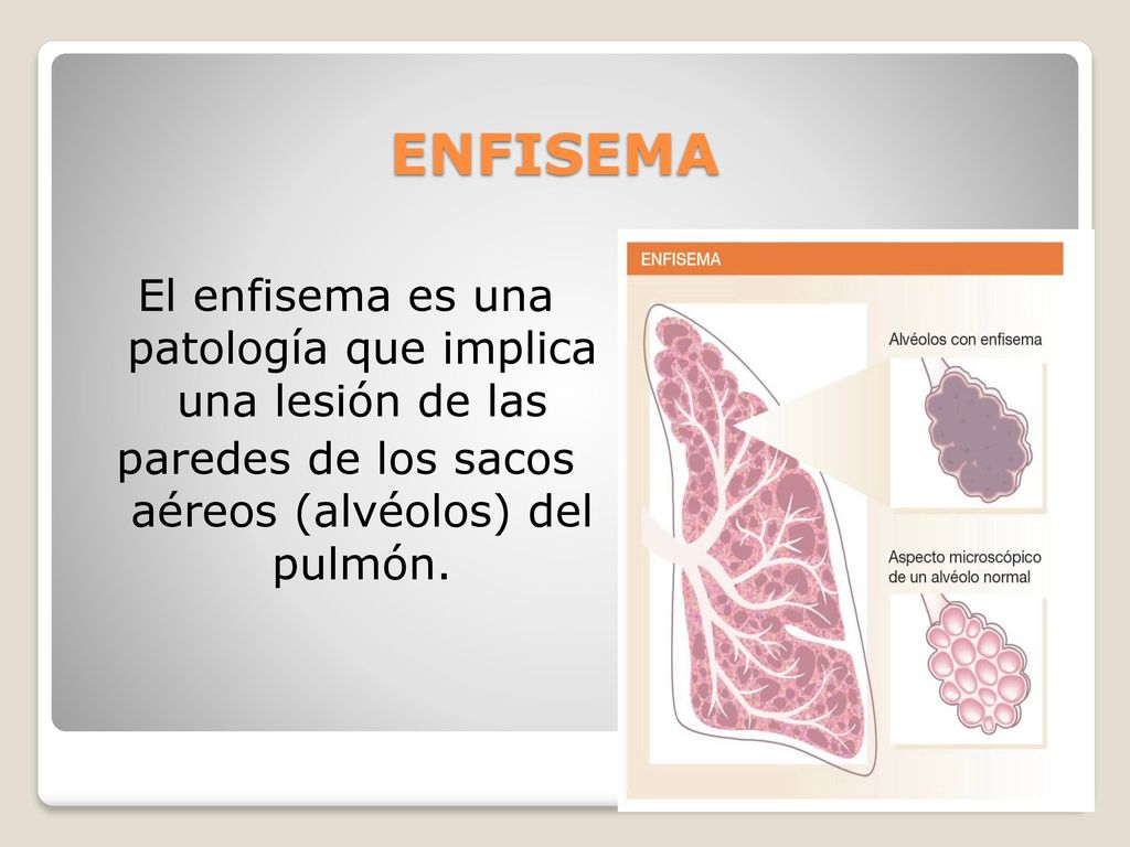 ENFISEMA El enfisema es una patología que implica una lesión de las paredes de los sacos aéreos (alvéolos) del pulmón.
