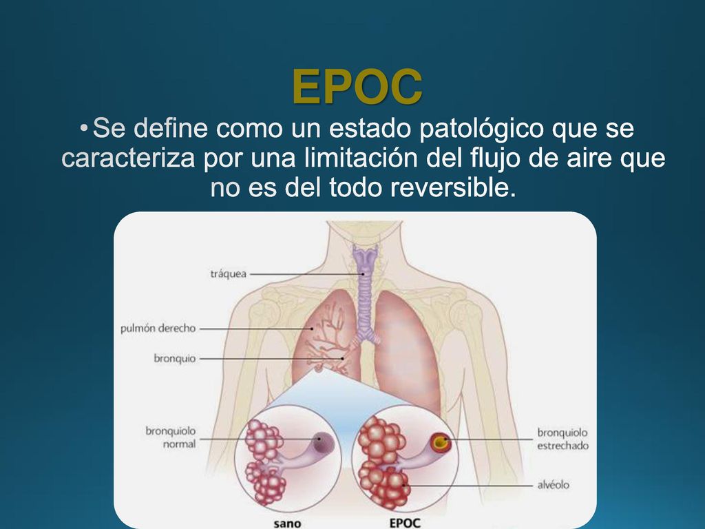 EPOC Se define como un estado patológico que se caracteriza por una limitación del flujo de aire que no es del todo reversible.