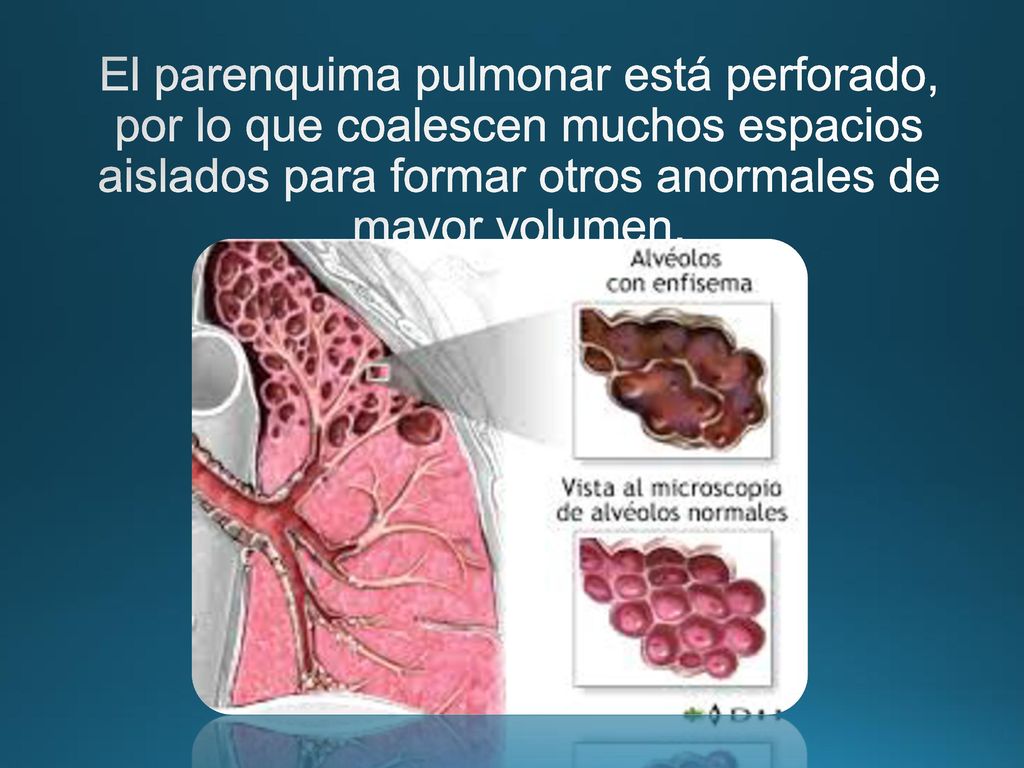El parenquima pulmonar está perforado, por lo que coalescen muchos espacios aislados para formar otros anormales de mayor volumen.