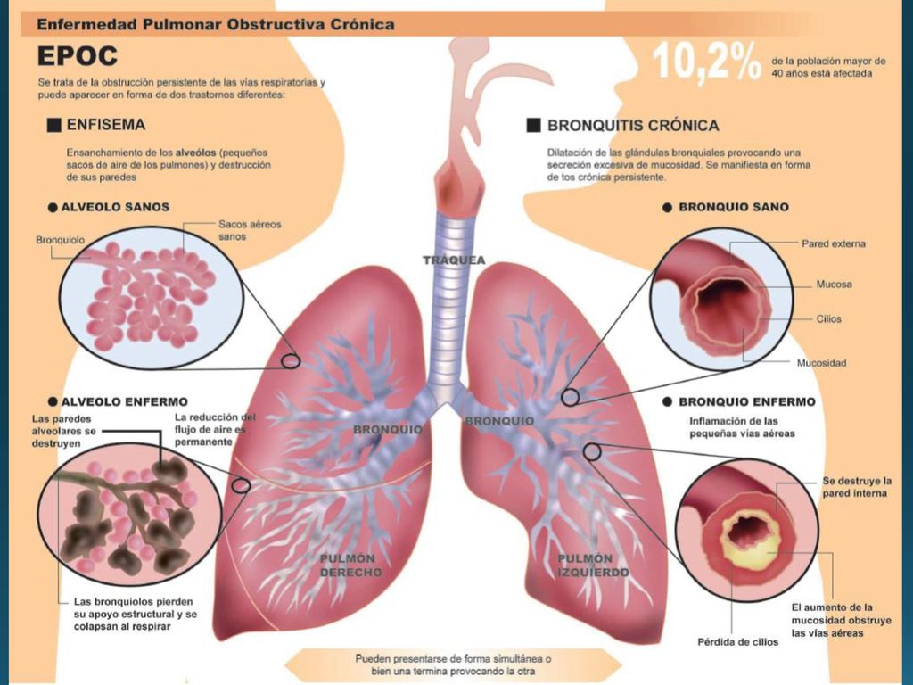 ENFISEMA: Hipotesis de la elastasa:antielastasa por deficiencia de antitripsina alfa 1 (inhibidor de proteasa serico.