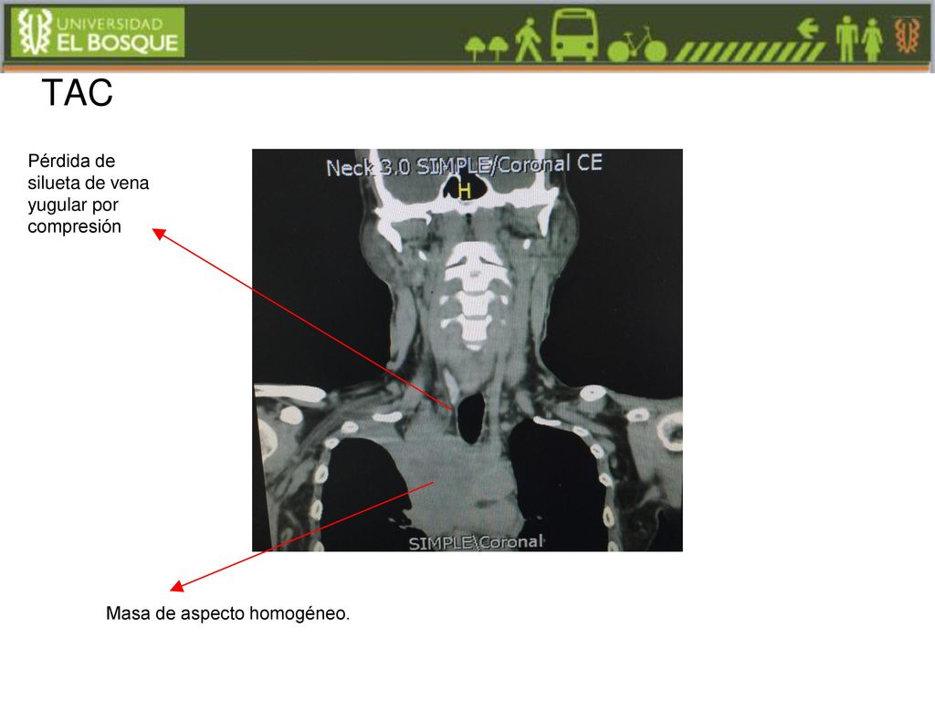 TAC Pérdida de silueta de vena yugular por compresión
