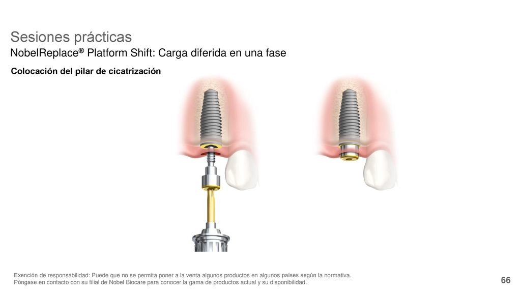 8/25/2018 Sesiones prácticas. NobelReplace® Platform Shift: Carga diferida en una fase. Colocación del pilar de cicatrización.
