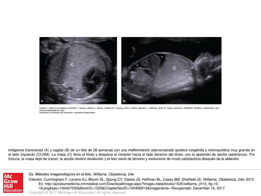 Imágenes transversal (A) y sagital (B) de un feto de 26 semanas con una malformación adenomatoide quística congénita y microquística muy grande en el lado izquierdo (CCAM). La masa (C) llena el tórax y desplaza el corazón hacia el lado derecho del tórax, con la aparición de ascitis (asteriscos). Por fortuna, la masa dejó de crecer; la ascitis mostró resolución y el feto nació de término y evolucionó de modo satisfactorio después de la ablación.
