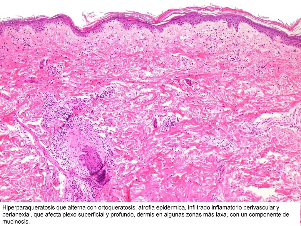 Hiperparaqueratosis que alterna con ortoqueratosis, atrofia epidérmica, infiltrado inflamatorio perivascular y perianexial, que afecta plexo superficial y profundo, dermis en algunas zonas más laxa, con un componente de mucinosis.