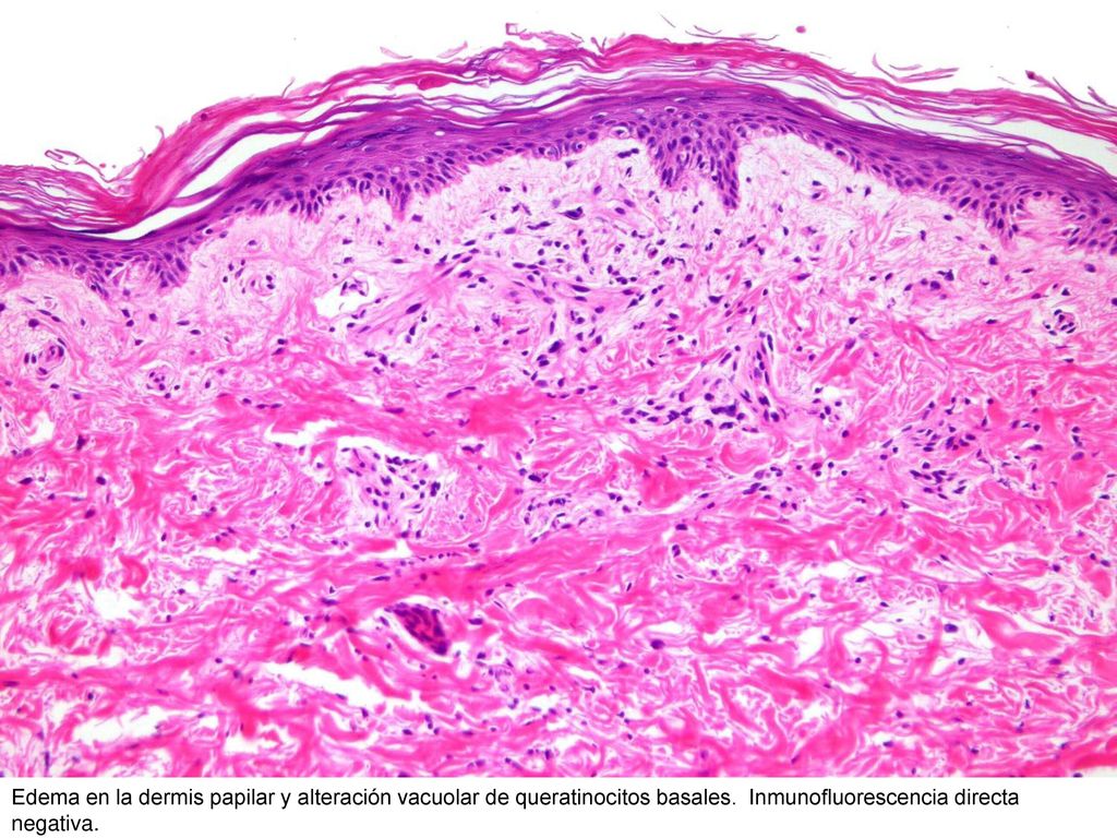Edema en la dermis papilar y alteración vacuolar de queratinocitos basales.