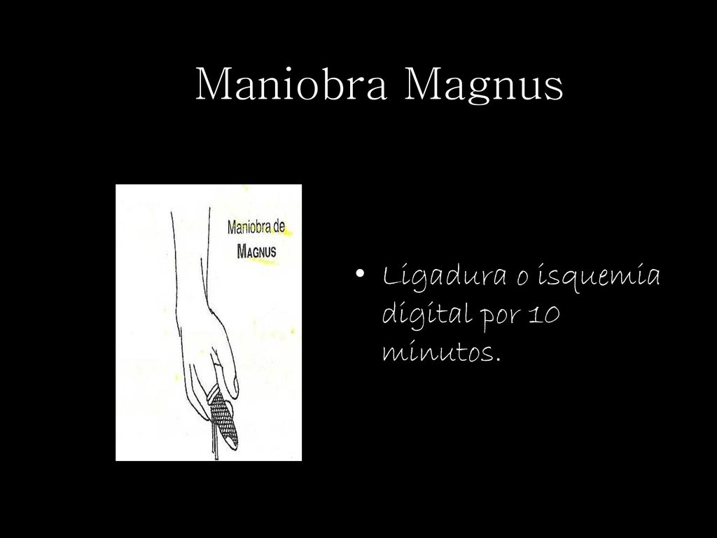 Maniobra Magnus Ligadura o isquemia digital por 10 minutos.
