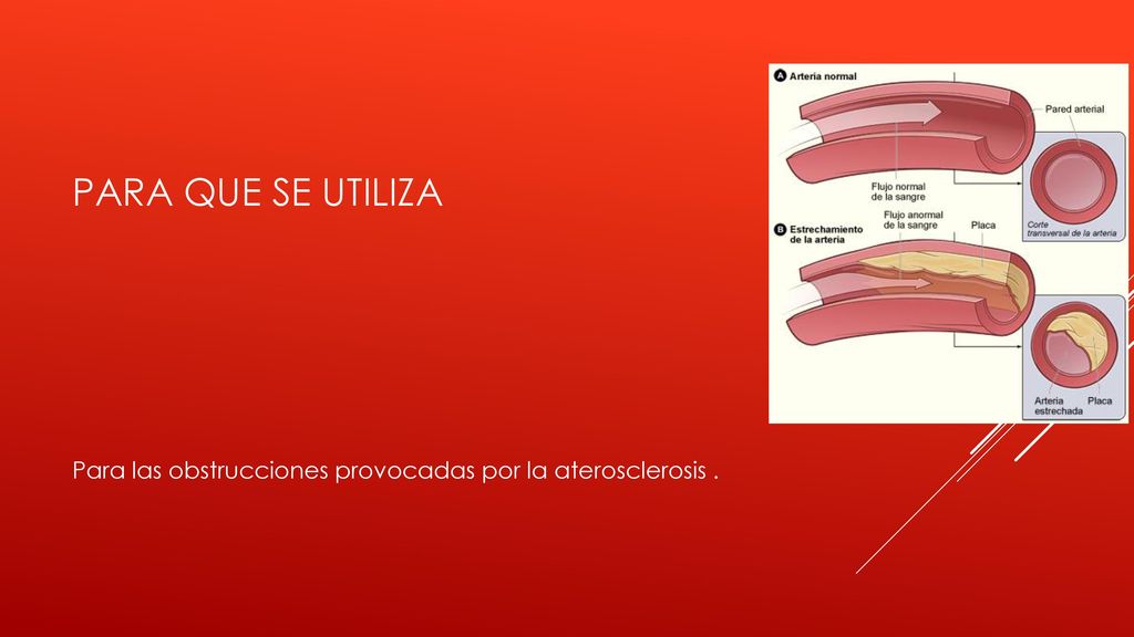 PARA QUE SE UTILIZA Para las obstrucciones provocadas por la aterosclerosis .