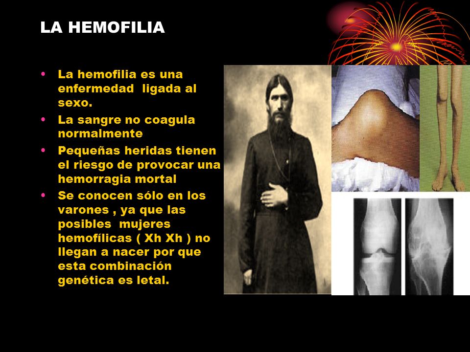LA HEMOFILIA La hemofilia es una enfermedad ligada al sexo.