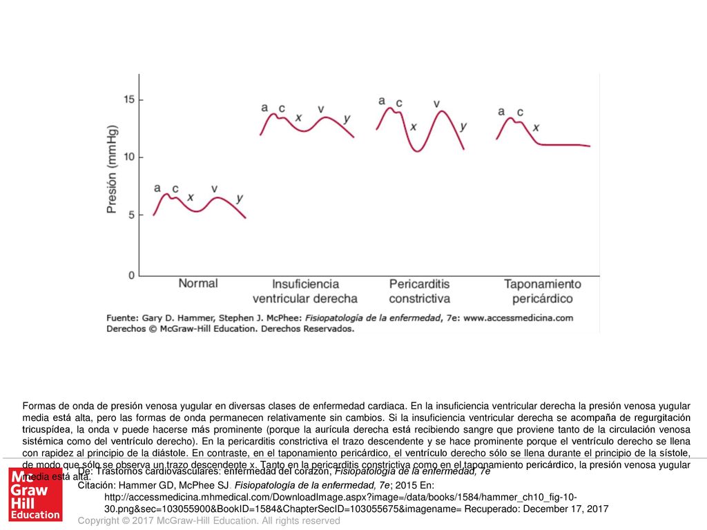 Formas de onda de presión venosa yugular en diversas clases de enfermedad cardiaca. En la insuficiencia ventricular derecha la presión venosa yugular media está alta, pero las formas de onda permanecen relativamente sin cambios. Si la insuficiencia ventricular derecha se acompaña de regurgitación tricuspídea, la onda v puede hacerse más prominente (porque la aurícula derecha está recibiendo sangre que proviene tanto de la circulación venosa sistémica como del ventrículo derecho). En la pericarditis constrictiva el trazo descendente y se hace prominente porque el ventrículo derecho se llena con rapidez al principio de la diástole. En contraste, en el taponamiento pericárdico, el ventrículo derecho sólo se llena durante el principio de la sístole, de modo que sólo se observa un trazo descendente x. Tanto en la pericarditis constrictiva como en el taponamiento pericárdico, la presión venosa yugular media está alta.