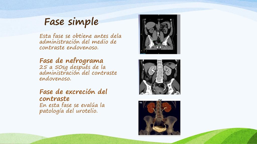 Fase simple Fase de nefrograma Fase de excreción del contraste