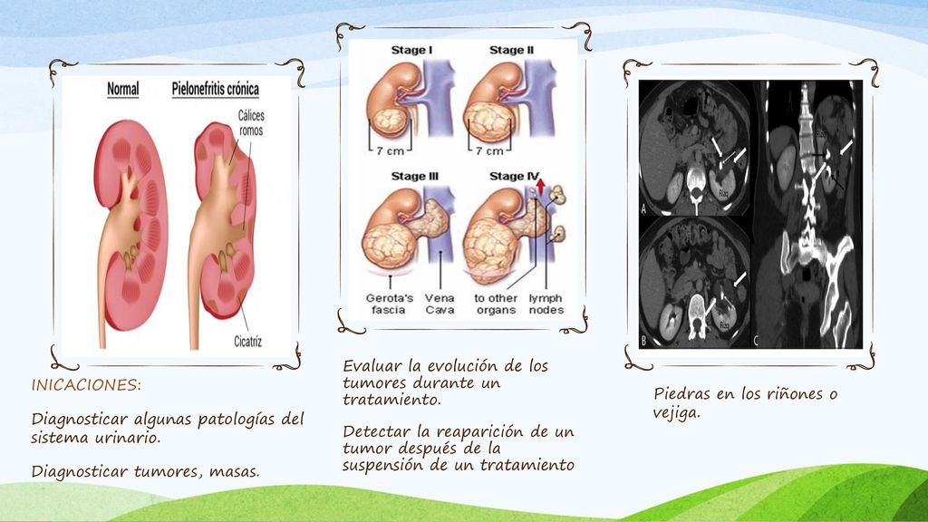 Evaluar la evolución de los tumores durante un tratamiento.