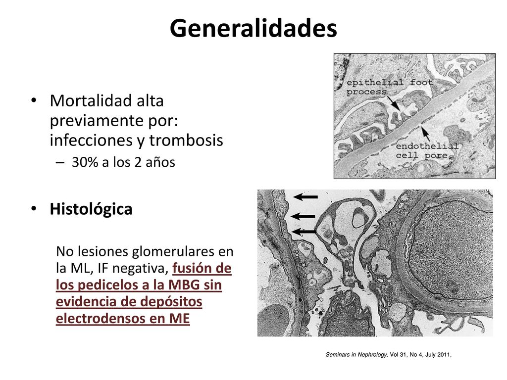 Generalidades Mortalidad alta previamente por: infecciones y trombosis