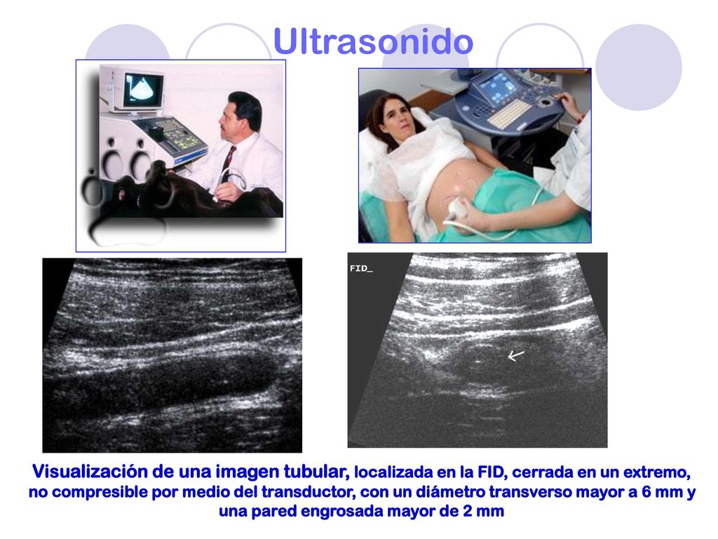 Ultrasonido Visualización de una imagen tubular, localizada en la FID, cerrada en un extremo,