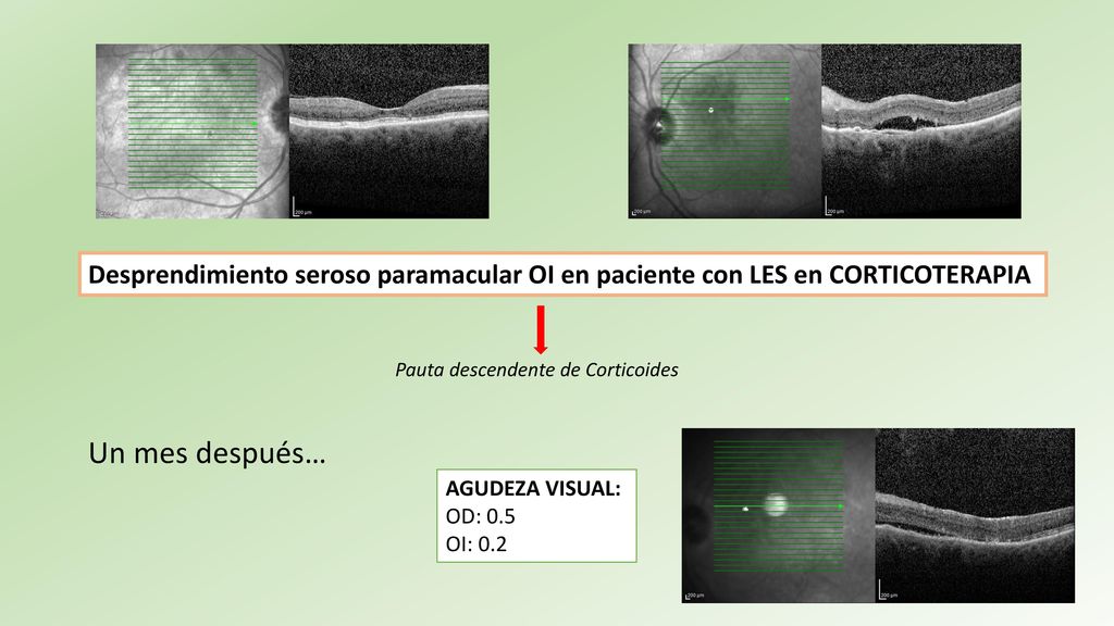 Desprendimiento seroso paramacular OI en paciente con LES en CORTICOTERAPIA