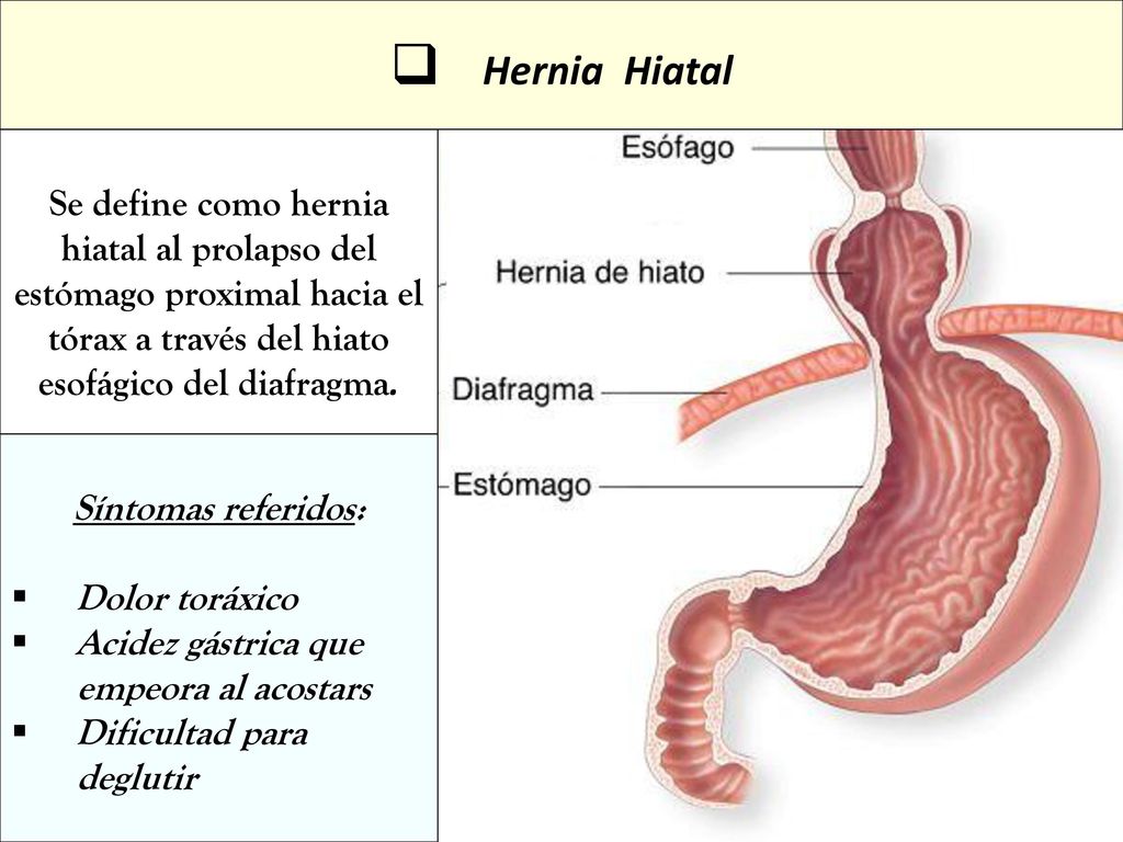 Hernia Hiatal Se define como hernia hiatal al prolapso del estómago proximal hacia el tórax a través del hiato esofágico del diafragma.