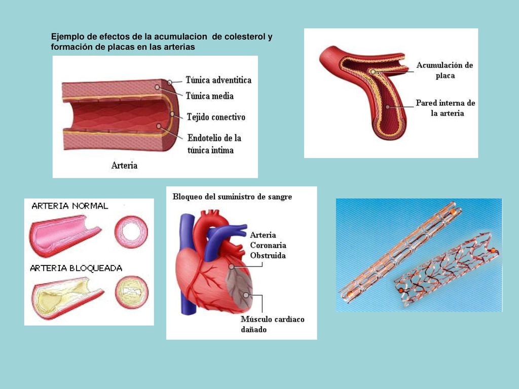 Ejemplo de efectos de la acumulacion de colesterol y formación de placas en las arterias