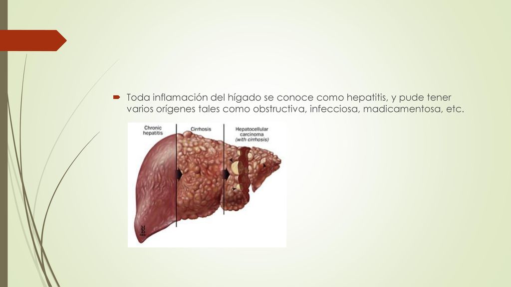 Toda inflamación del hígado se conoce como hepatitis, y pude tener varios orígenes tales como obstructiva, infecciosa, madicamentosa, etc.