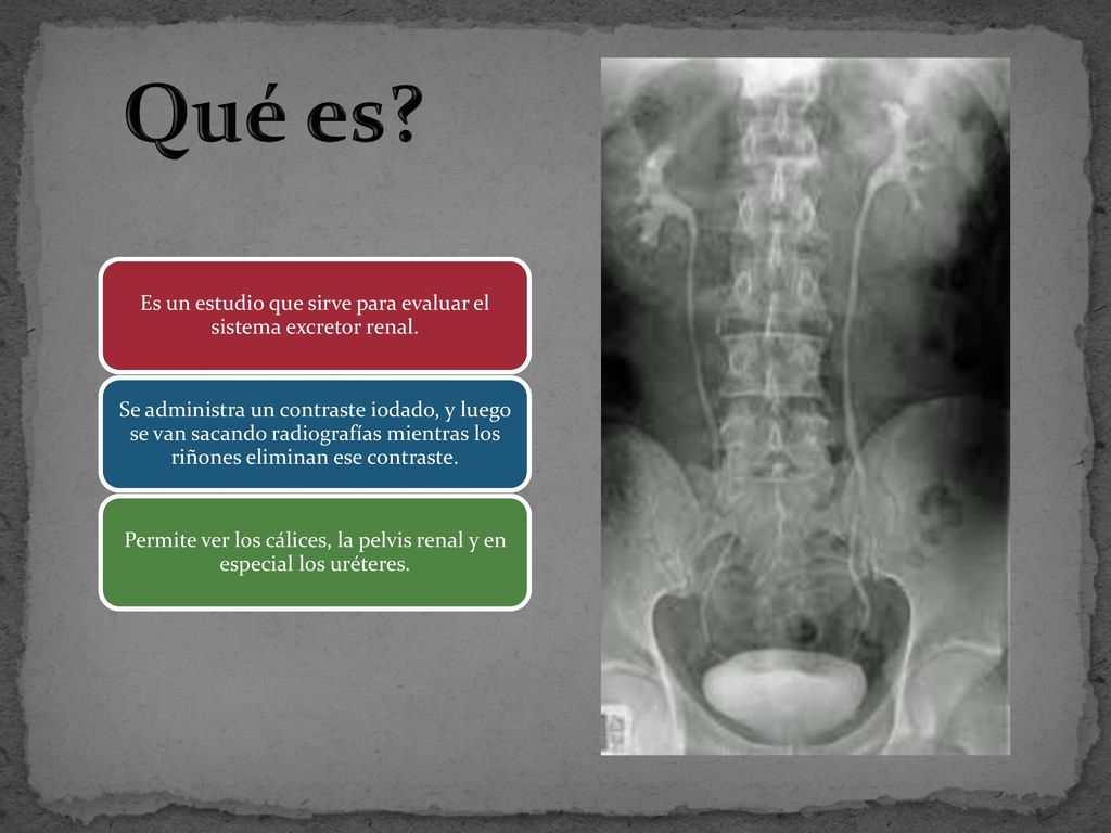 Qué es Es un estudio que sirve para evaluar el sistema excretor renal.