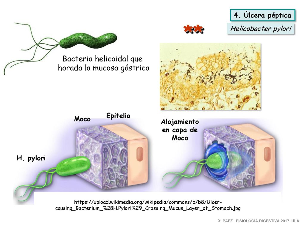 ** Bacteria helicoidal que horada la mucosa gástrica 4. Úlcera péptica