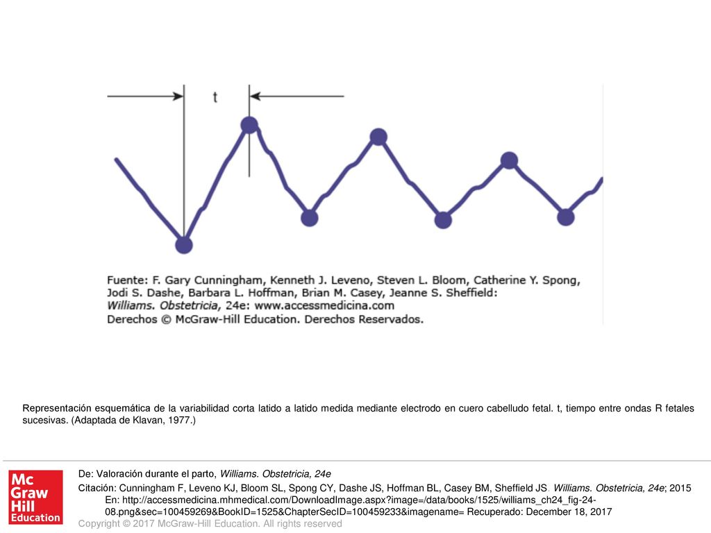 Representación esquemática de la variabilidad corta latido a latido medida mediante electrodo en cuero cabelludo fetal. t, tiempo entre ondas R fetales sucesivas. (Adaptada de Klavan, 1977.)