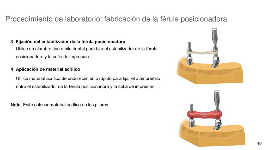 Procedimiento de laboratorio: fabricación de la férula posicionadora