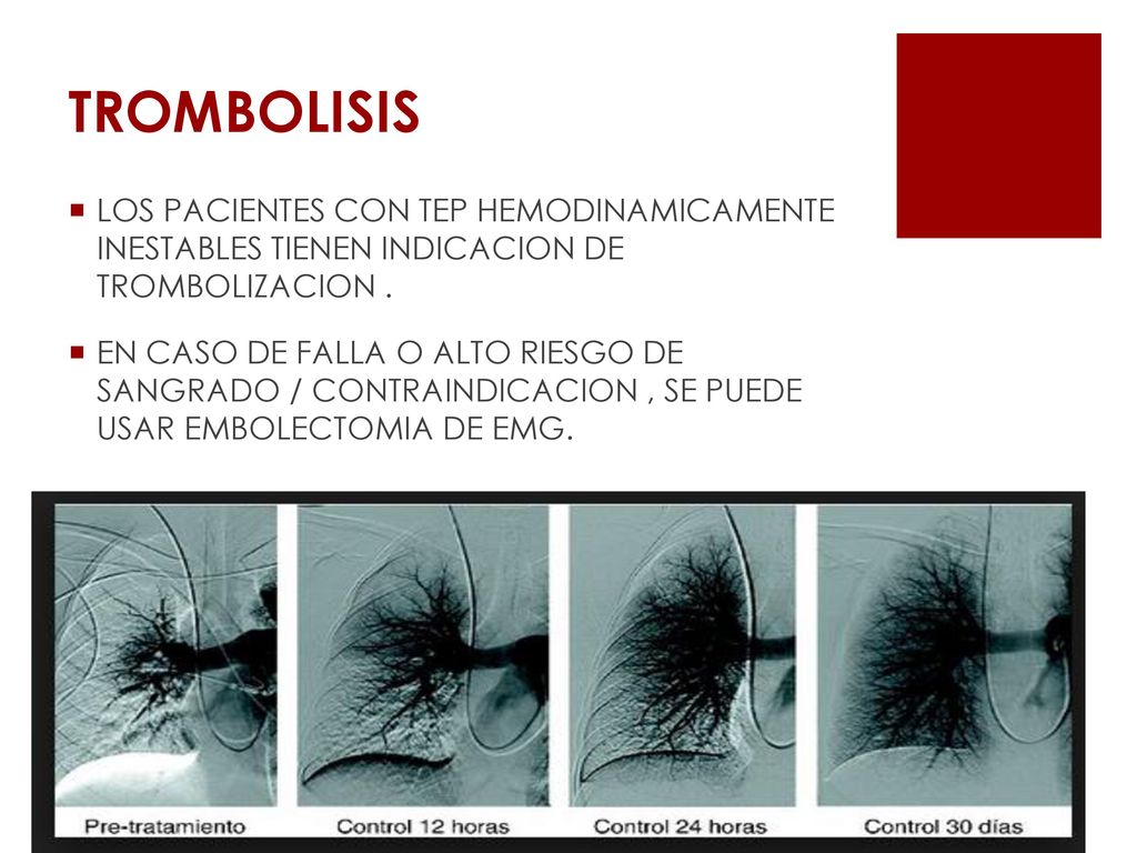 TROMBOLISIS LOS PACIENTES CON TEP HEMODINAMICAMENTE INESTABLES TIENEN INDICACION DE TROMBOLIZACION .