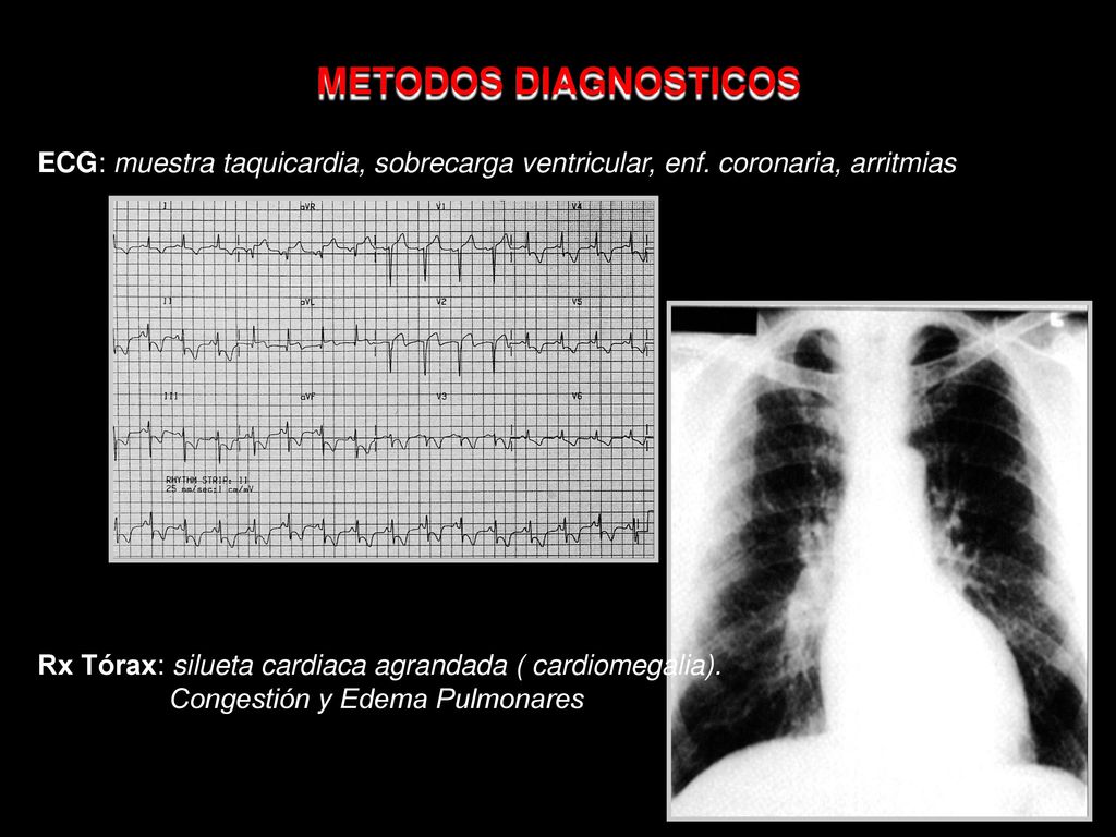 METODOS DIAGNOSTICOS ECG: muestra taquicardia, sobrecarga ventricular, enf. coronaria, arritmias.