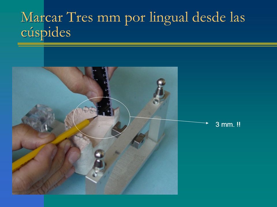 Marcar Tres mm por lingual desde las cúspides