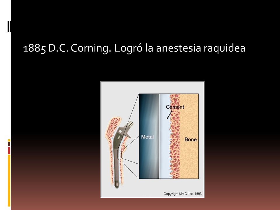 1885 D.C. Corning. Logró la anestesia raquidea