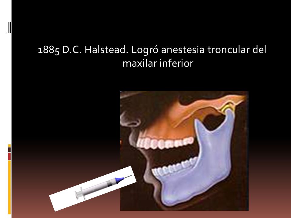 1885 D.C. Halstead. Logró anestesia troncular del maxilar inferior