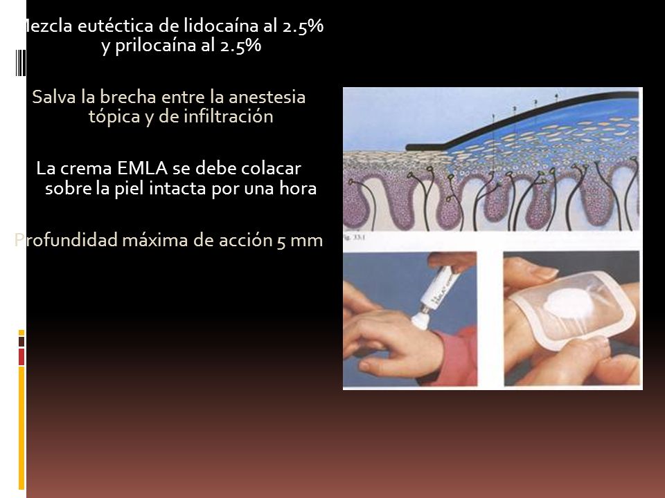 Mezcla eutéctica de lidocaína al 2.5% y prilocaína al 2.5%