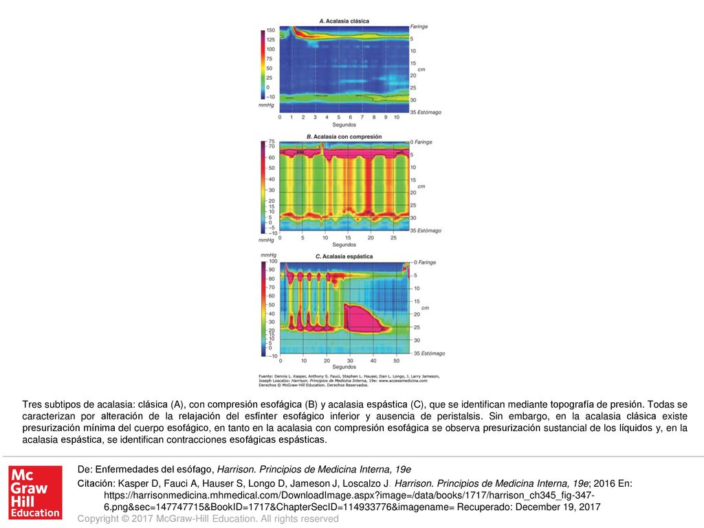 Tres subtipos de acalasia: clásica (A), con compresión esofágica (B) y acalasia espástica (C), que se identifican mediante topografía de presión. Todas se caracterizan por alteración de la relajación del esfínter esofágico inferior y ausencia de peristalsis. Sin embargo, en la acalasia clásica existe presurización mínima del cuerpo esofágico, en tanto en la acalasia con compresión esofágica se observa presurización sustancial de los líquidos y, en la acalasia espástica, se identifican contracciones esofágicas espásticas.