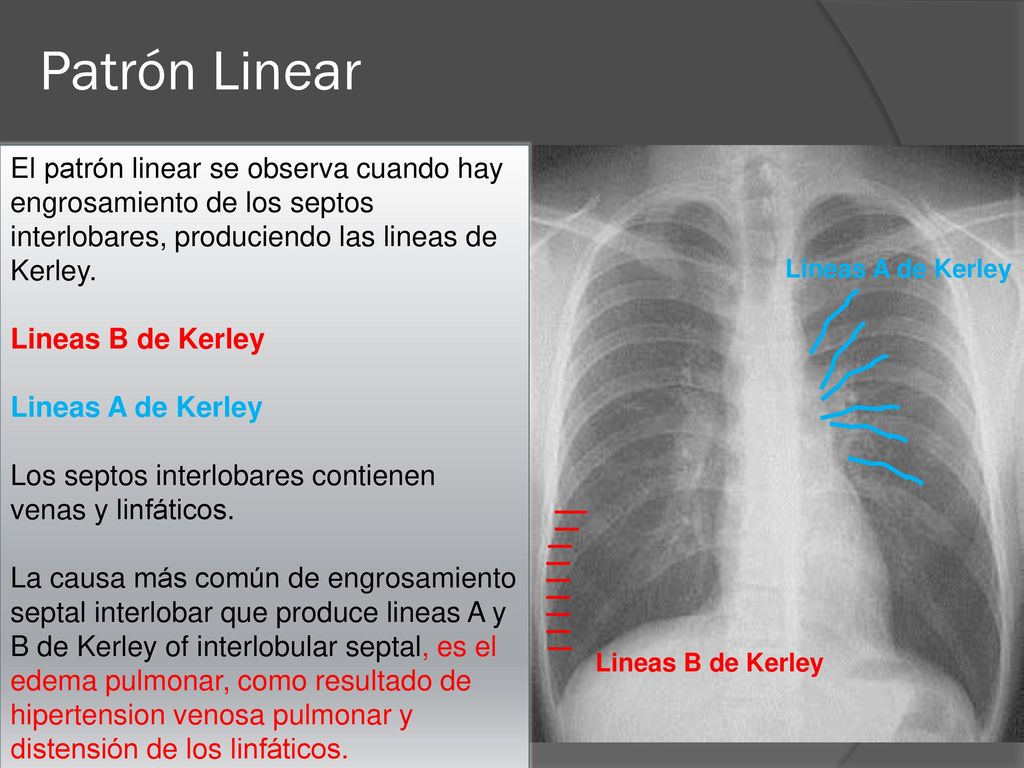 Patrón Linear El patrón linear se observa cuando hay engrosamiento de los septos interlobares, produciendo las lineas de Kerley.