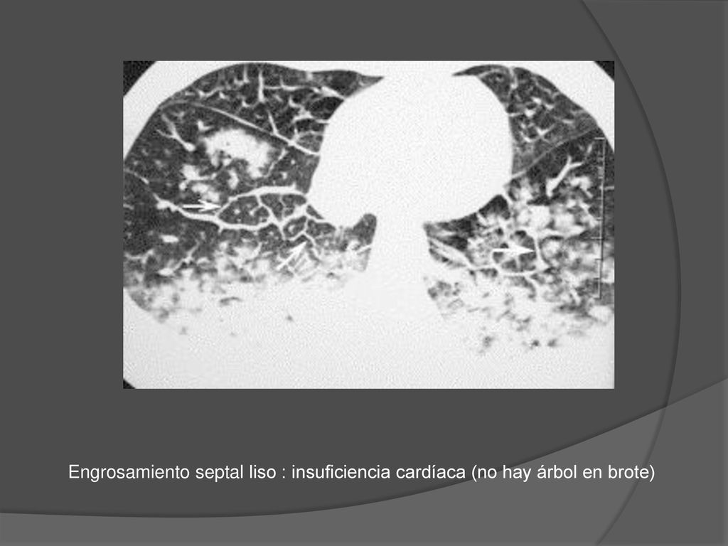 Engrosamiento septal liso : insuficiencia cardíaca (no hay árbol en brote)