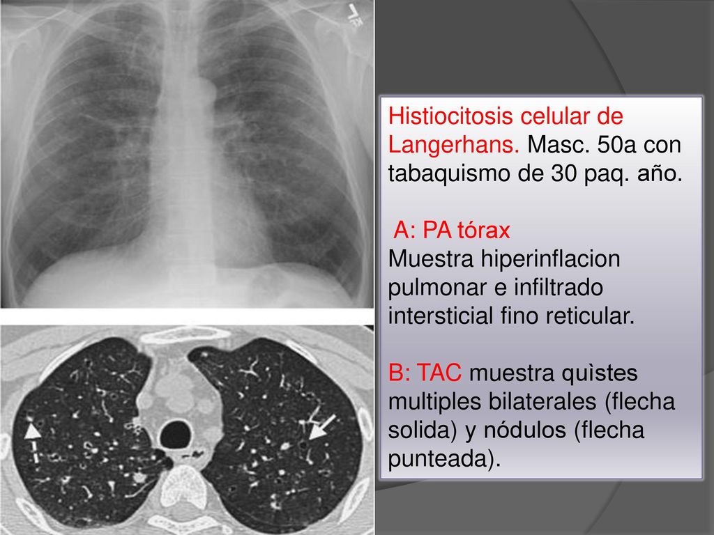 Histiocitosis celular de Langerhans. Masc. 50a con tabaquismo de 30 paq. año.