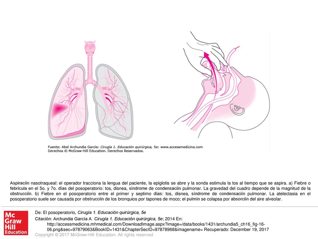 Aspiraciín nasotraqueal: el operador tracciona la lengua del paciente, la epiglotis se abre y la sonda estimula la tos al tiempo que se aspira. a) Fiebre o febrícula en el 5o. y 7o. días del posoperatorio: tos, disnea, síndrome de condensaciín pulmonar. La gravedad del cuadro depende de la magnitud de la obstrucciín. b) Fiebre en el posoperatorio entre el primer y septimo días: tos, disnea, síndrome de condensaciín pulmonar. La atelectasia en el posoperatorio suele ser causada por obstrucciín de los bronquios por tapones de moco; el pulmín se colapsa por absorciín del aire alveolar.