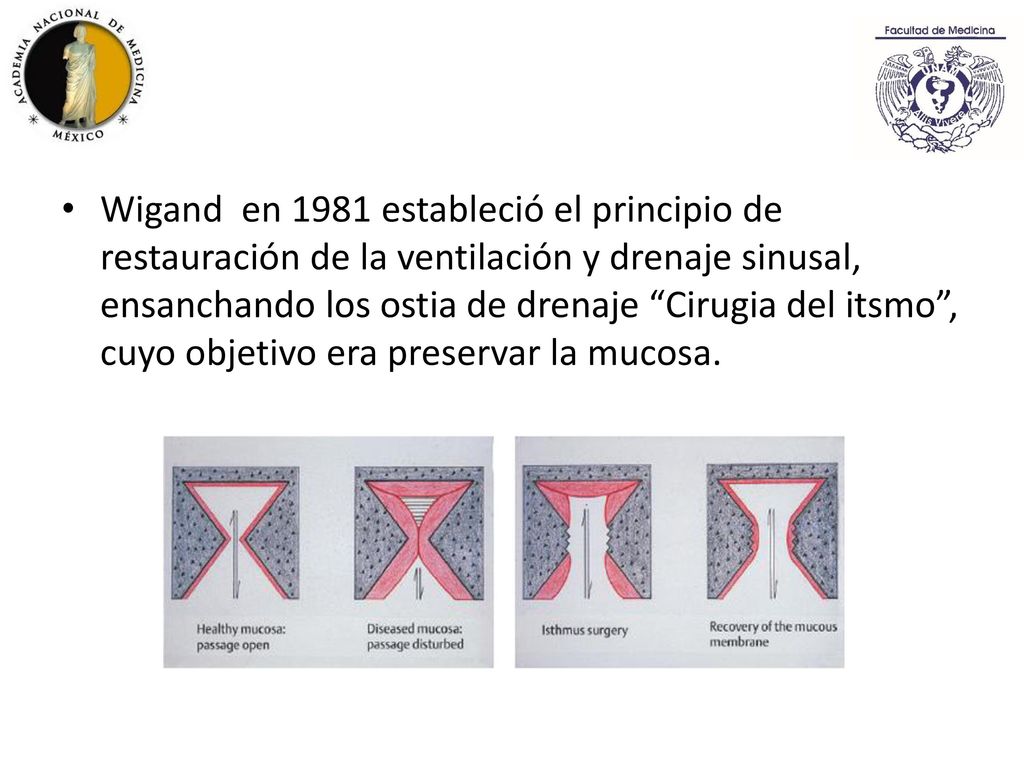 Wigand en 1981 estableció el principio de restauración de la ventilación y drenaje sinusal, ensanchando los ostia de drenaje Cirugia del itsmo , cuyo objetivo era preservar la mucosa.