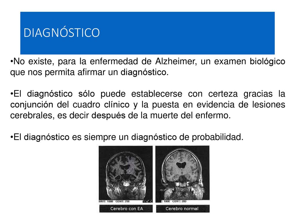 DIAGNÓSTICO No existe, para la enfermedad de Alzheimer, un examen biológico que nos permita afirmar un diagnóstico.