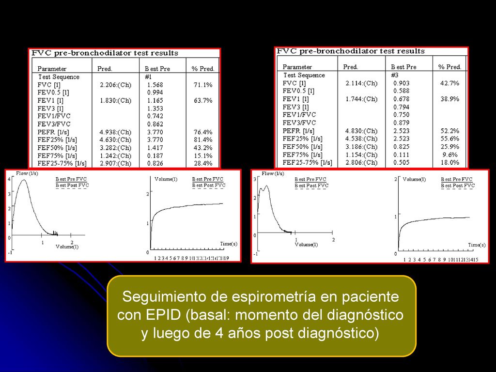 Seguimiento de espirometría en paciente con EPID (basal: momento del diagnóstico y luego de 4 años post diagnóstico)