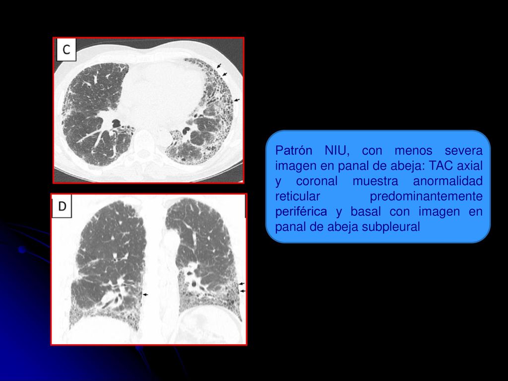 Patrón NIU, con menos severa imagen en panal de abeja: TAC axial y coronal muestra anormalidad reticular predominantemente periférica y basal con imagen en panal de abeja subpleural