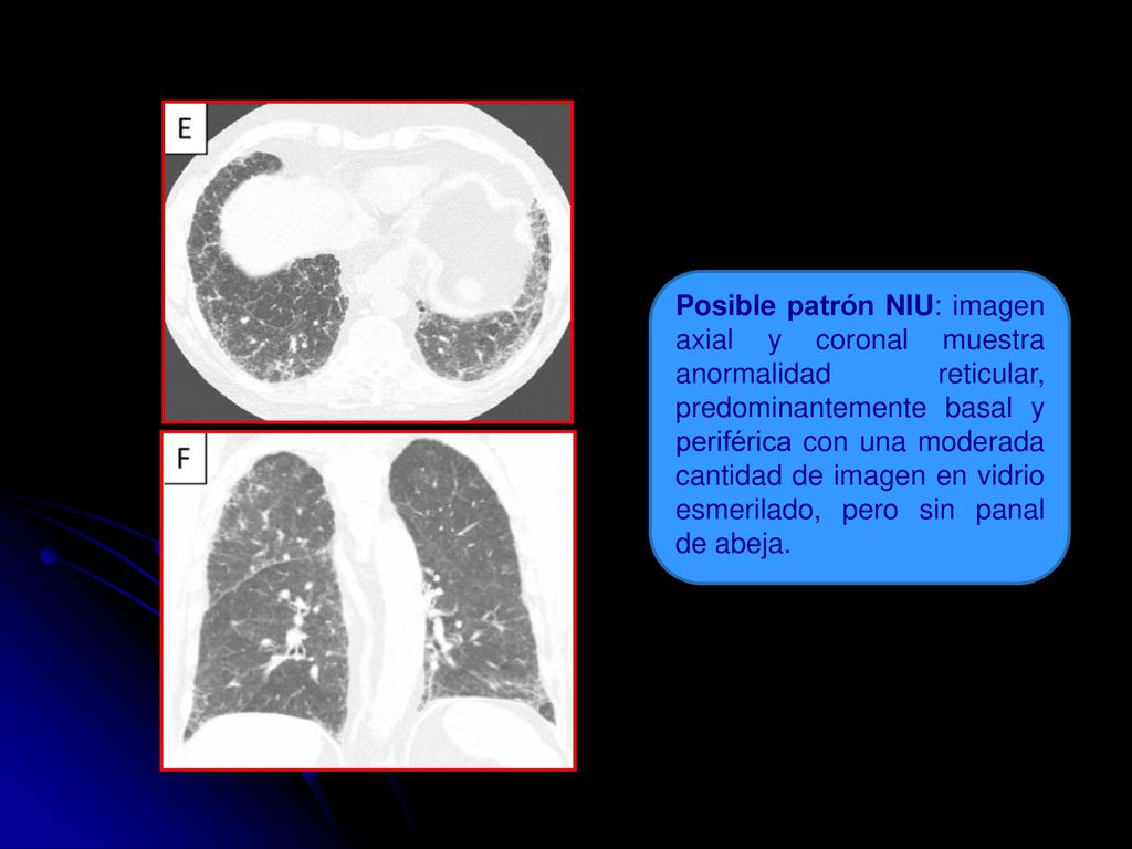 Posible patrón NIU: imagen axial y coronal muestra anormalidad reticular, predominantemente basal y periférica con una moderada cantidad de imagen en vidrio esmerilado, pero sin panal de abeja.