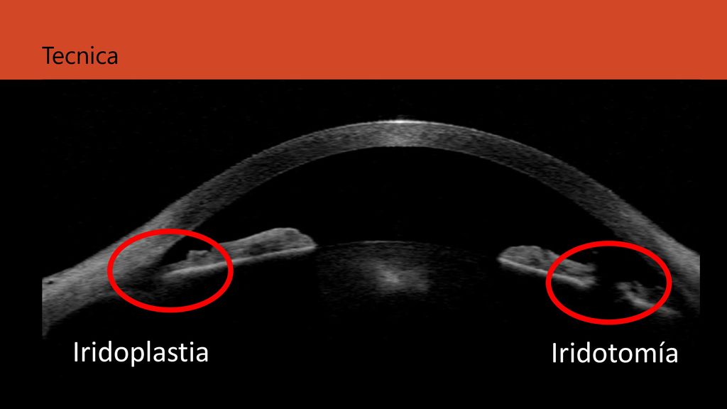 Corectopia Tecnica IPL + Iridotomia Iridoplastia Iridotomía