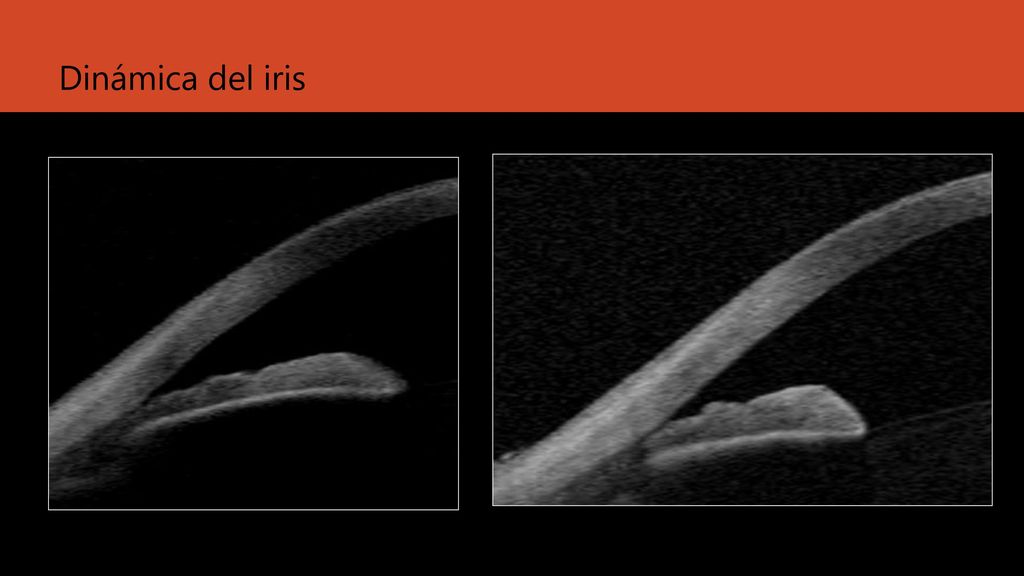 Corectopia Dinámica del iris Dinamica del iris
