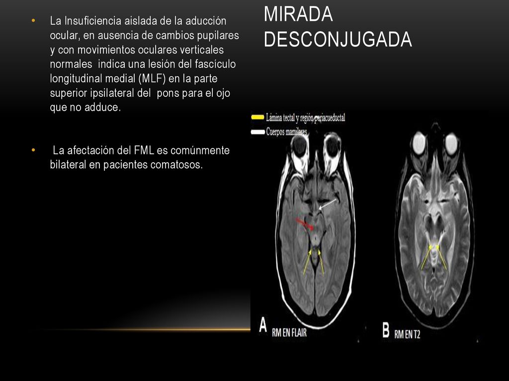 La Insuficiencia aislada de la aducción ocular, en ausencia de cambios pupilares y con movimientos oculares verticales normales indica una lesión del fascículo longitudinal medial (MLF) en la parte superior ipsilateral del pons para el ojo que no adduce.